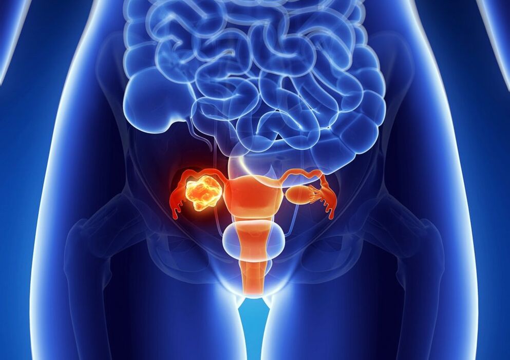 Women's ovary pathology under the influence of alcohol